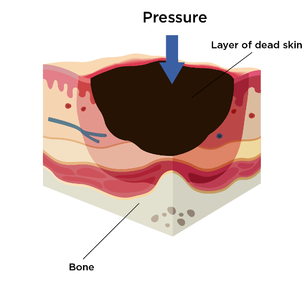 Unstageable Pressure Ulcers: Causes and Treatment - easecushion