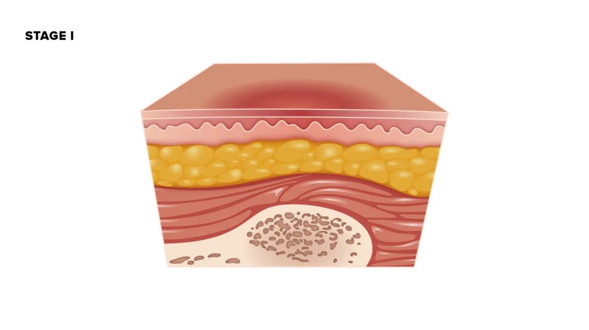 Pressure Sores: Causes and Treatment - easecushion