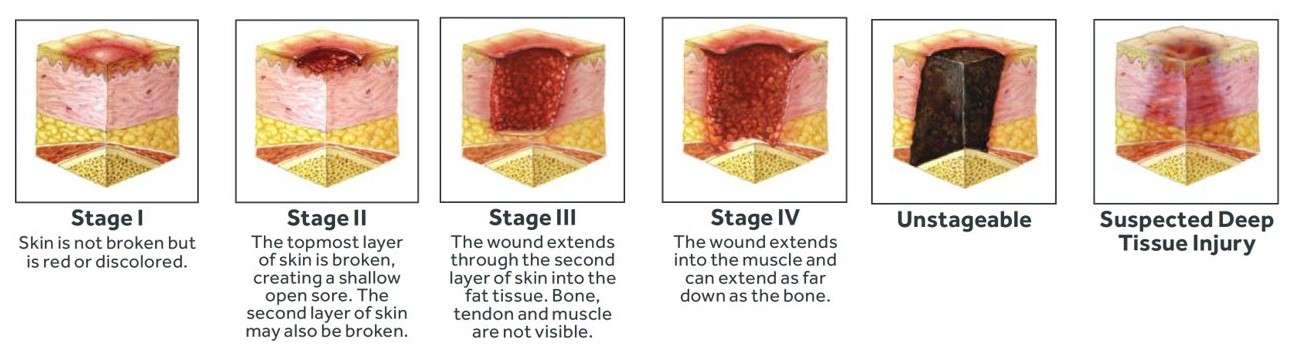 Pressure Sores kill 60,000 Americans - What wheelchair users must learn about decubitus ulcers or pressure injuries? - easecushion